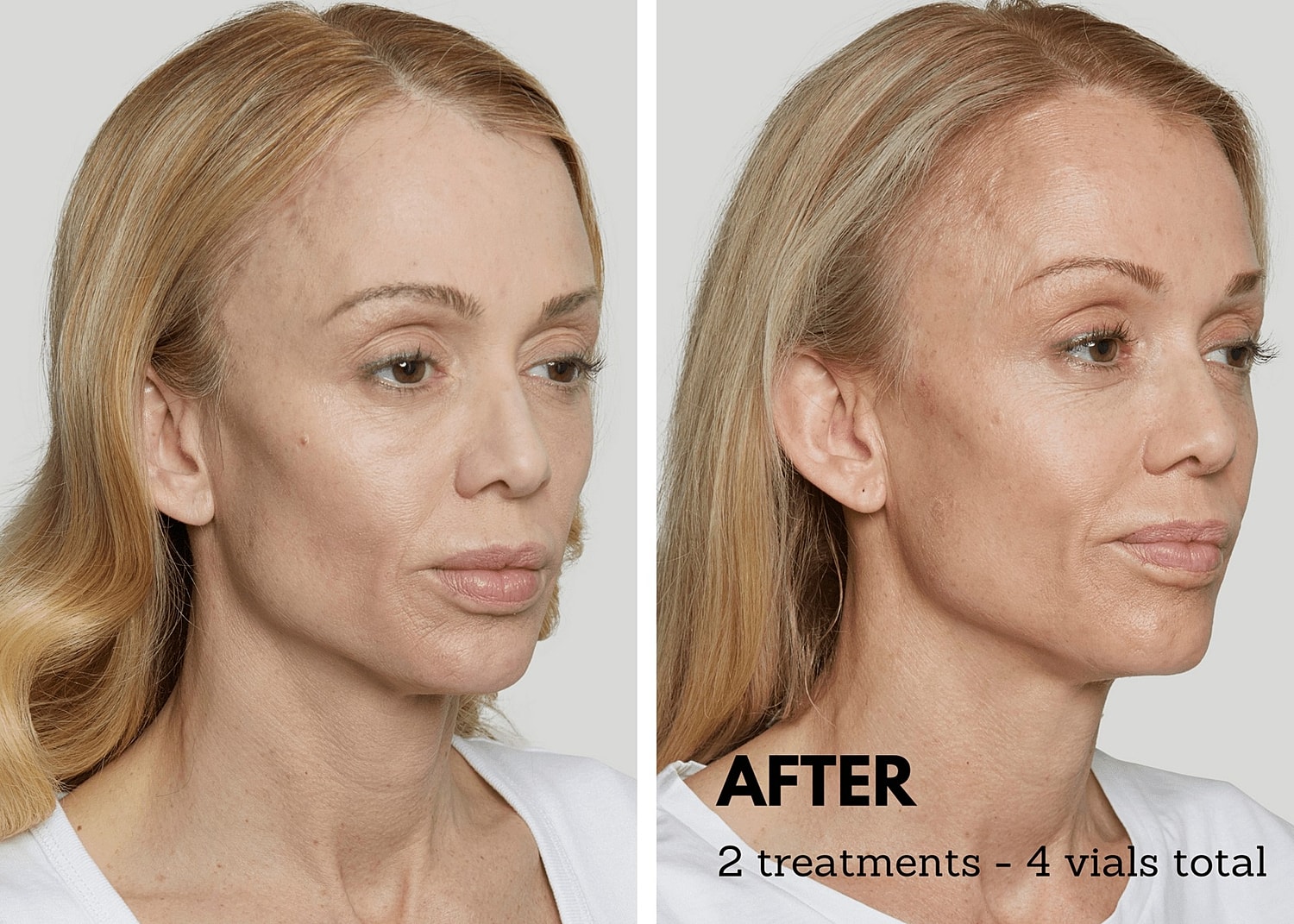 Rising Demand for a Natural Look: Why Sculptra is Gaining Popularity in Cosmetic Treatments