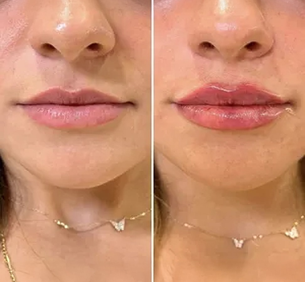 Before and after lip enhancement comparison photo.