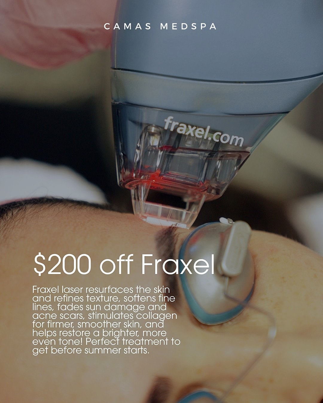 Fraxel laser treatment at Camas Medspa promotion